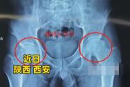 28岁小伙酒龄10年致股骨头坏死 内幕曝光简直太意外了