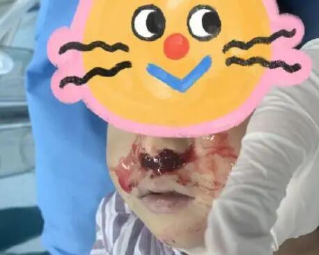 奶奶向3岁男童鼻腔塞头发止血 内幕曝光简直太意外了