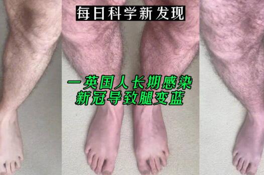 一英国人长期感染新冠导致腿变蓝 内幕曝光简直太意外了