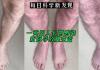 一英国人长期感染新冠导致腿变蓝 背后真相实在让人惊愕