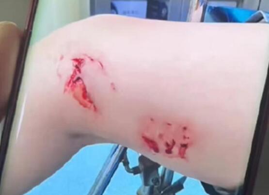 北海被鱼咬伤者称曾踩到软软的东西 背后真相实在让人惊愕