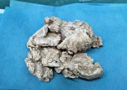 男子为解决漏尿将吸水棉塞入尿道 背后真相实在让人惊愕