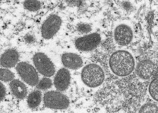 怎么判断自己得了猴痘?专家解答 背后真相实在让人惊愕