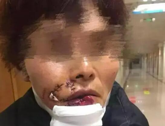 女子被狗撕碎左脸缝了500多针 内幕曝光简直太意外了