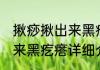 揪痧揪出来黑疙瘩消息推荐 揪痧揪出来黑疙瘩详细介绍